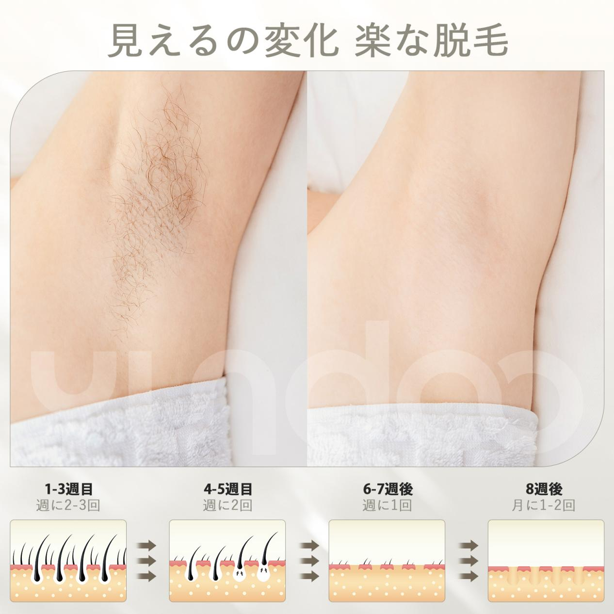 YUNDOO 脱毛器 だつもうき 【2024最新サロン級IPL脱毛器】 無痛脱毛メンズ レディース 99万回照射 VIO対応 5段階調節 冷感脱毛器 光脱毛器 顔 髭 脇 腕 足用 全身ムダ毛処理 家庭用 男女兼用 母の日ギフトプレゼント 保護眼鏡付き 24ヶ月保証